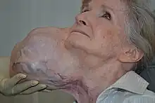 A 71-year-old woman with a massive tumour protuding from the side of her head and neck