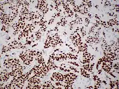 Immunohistochemistry of estrogen receptor in invasive breast cancer, showing nuclear staining.