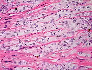 Poorly differentiated, where attempts at keratinization are often no longer evident. This is a clear-cell squamous-cell carcinoma. The dysplastic cells infiltrated cords through the dermis. Poorly differentiated cSCC has greatly enlarged pleomorphic nuclei showing a&nbsp;high degree of atypia and frequent mitoses.