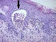 Micrograph: Subepidermal blister formation and neutrophils
