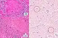 Histopathology, showing epithelioid granulomas with multinucleated giant cells and acid-fast bacilli