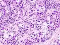 Histopathologic image of mucoepidermoid carcinoma of the major salivary gland. The same lesion as shown in a filename "Mucoepidermoid carcinoma (2) HE stain.jpg". H & E stain