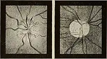 The illustration on the left depicts optic neuritis. The illustration on the right depicts atrophy of the optic nerve.