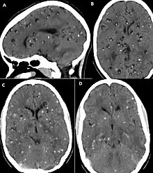  CT scan of neurocysticercosis before and after treatment