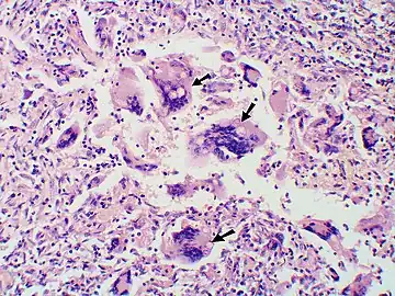 Large yeast-like fungi seen within giant cells at arrows.