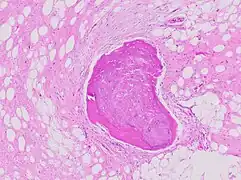 Bone formation may be seen in both lipomas and liposarcomas (a well-differentiated one pictured).