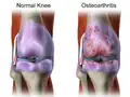 Osteoarthritis