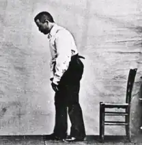 The stooped posture of a patient with Parkinson's