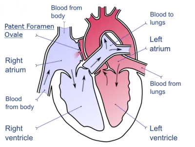 A drawing depicting a patent foramen ovale