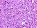 Salt-and-pepper chromatin (pheochromocytoma). H&E stain.