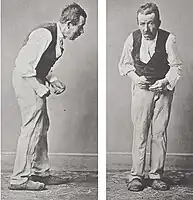Side and front views of a Parkinson's patient, illustrating hunched posture.