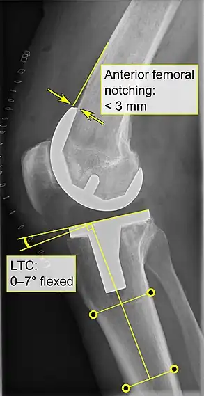 - Anterior femoral notching (the femoral component causing reduced thickness of the distal femur anteriorly), seems to cause an increased risk of fractures when exceeding about 3&nbsp;mm.- LTC: lateral (or sagittal) tibial component angle, which is ideally positioned so that the tibia is 0–7° flexed compared to at a right angle with the tibial plate.