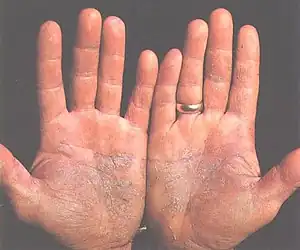 Psoriasis of the palms
