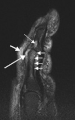 Magnetic resonance image of the index finger in psoriatic arthritis (mutilans form). Shown is a T2 weighted fat suppressed sagittal image. A focal increased signal (probable erosion) is seen at the base of the middle phalanx (long thin arrow). There is synovitis at the proximal interphalangeal joint (long thick arrow) plus increased signal in the overlying soft tissues indicating edema (short thick arrow). There is also diffuse bone edema (short thin arrows) involving the head of the proximal phalanx and extending distally down the shaft.