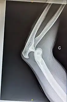 X-ray of left elbow posterior joint dislocation without fracture