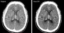 Original (left side) compared to reconstructed (right side) brain image produced from CT scans with low radiation dose. Reconstruction method improves image quality for accurate diagnosis.