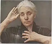 Erythema multiforme of head and limbs