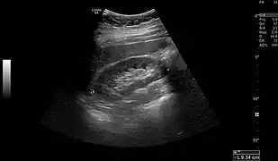 Normal adult right kidney as seen on abdominal ultrasound with a pole to pole measurement of 9.34&nbsp;cm