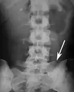 Sacralization of the L5 vertebra is seen at the lower right of the image.