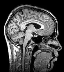 Median plane magnetic resonance imaging of the head.