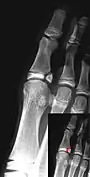 Salter–Harris IV fracture of big toe proximal phalanx.