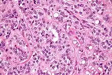 High magnification micrograph of a Sertoli cell tumour. H&E stain.