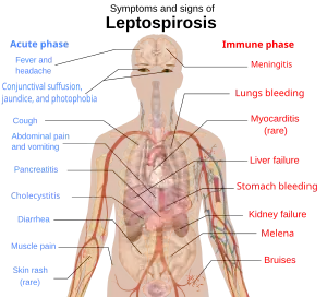 A schematic of the human body showing the symptoms and signs of leptospirosis