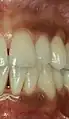 Smoker's melanosis in upper and lower gums