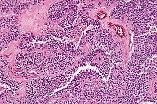 Histopathology of a solid pseudopapillary tumour. H&E stain. This case also shows the key feature of intracytoplasmic hyaline globules.