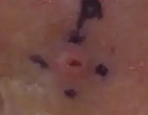 SCC, left lateral canthus marked for biopsy