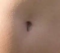 A "T"-shaped "innie" navel