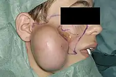 Using tissue expander to provide more skin