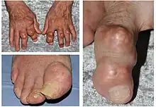 photos of hands and feet affected by gout.