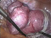 Transvaginal extraction of the uterus in total laparoscopical hysterectomy
