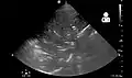 Pneumonia seen by ultrasound