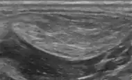 Medical ultrasonography of a lipoma in the thenar eminence: It is hyperechoic compared to adjacent muscle, and relatively well-defined, with miniature hyperechoic lines.