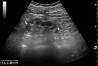 Chronic pyelonephritis with reduced kidney size and focal cortical thinning. Measurement of kidney length on the US image is illustrated by ‘+’ and a dashed line.