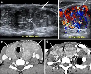 Fig. 14. A 19-year-old male patient known to have multi-nodular goiter and FNA, showing underlying Hashimoto's thyroiditis. a, b Sagittal and transverse greyscale and colour Doppler ultrasound of the neck demonstrate a hypoechoic enlarged right thyroid lobe with small hyperechoic regenerative nodules and marked hypervascularity (white arrows). c, d Enhanced axial CT scan images of the neck demonstrate a heterogeneously enhancing and enlarged thyroid gland, left more than right lobe, and the trachea is markedly narrowed.