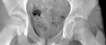 Figure 2C. AP view of a patient with left hip effusion secondary to trauma showing widening of the medial joint space.