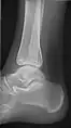 Lateral (this one a bit suboptimal by not seeing straight through the ankle joint)