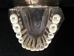 ISO notation lower jaw (wisdom teeth removed)