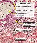 Histopathology of a chorionic villus, in a tubal pregnancy, with labeled cytotrophoblasts and syncytiotrophoblasts.