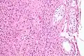 Intermediate magnification micrograph of a Leydig cell tumour, H&E stain