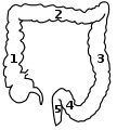 1: colon ascendent  2: colon transvers  3: colon descendent  4: colonul sigmoid  5: Rectum