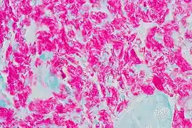 Noduli în mucoasa duodenală a unui pacient seropozitiv