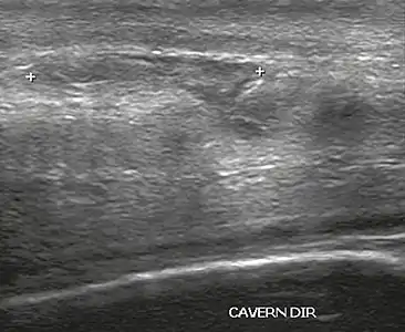 Figure 4 A: Ultrasound of the penis, right lateral view. Longitudinal section showing rupture of the tunica albuginea with an adjacent 1.92&nbsp;cm hematoma (between calipers), due to trauma.