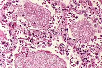 Spațiu alveolar ocupat de exsudat la un plămân cu Pneumocystis carinii