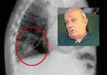 Pea growing in lungs