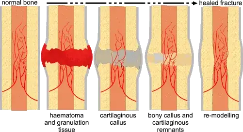 Healing process of broken bones