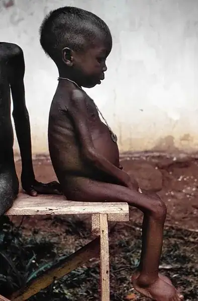 kwashiorkor